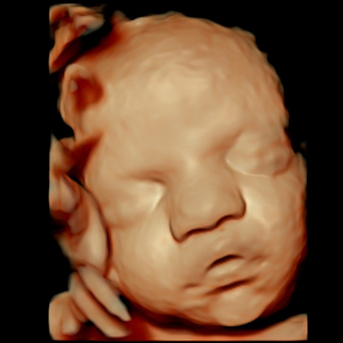 Imagem real de ultrassom 3D/4D usada como referência para o BABYVISION